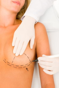 Breast Lift Augmentation | Sagging | Dallas Plastic Surgeon