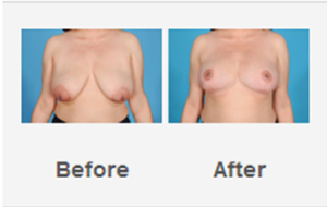 breast lift surgery augmentation before after photos dallas