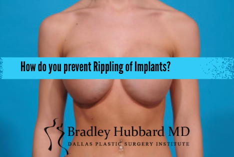 How do you prevent rippling in breast implants?