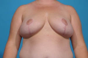 after breast reduction procedure - before and after - front