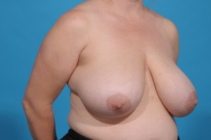 before breast reduction procedure - before and after - side