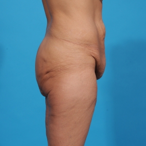 abdominoplasty, before surgery - lower body lift, side