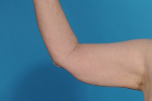 before arm lift surgery - brachioplasty before/after