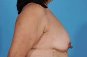 before breast augmentation, breast implants, breast lift