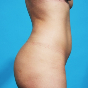 liposuction before surgery - before & after - side