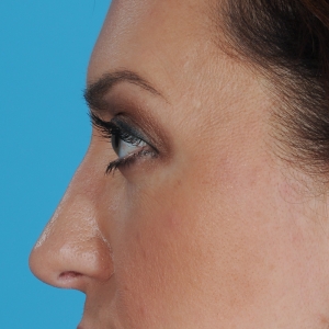 Rhinoplasty After Procedure - Nose Surgery Before & After, Profile