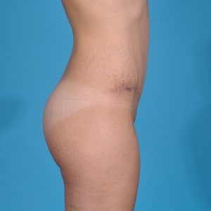 tummy tuck surgery - before & after - after, side