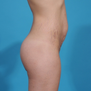 tummy tuck surgery - before & after - before side