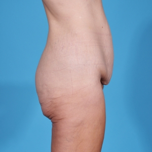 tummy tuck before and after - abdominoplasty side view