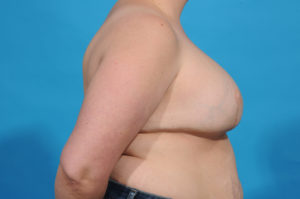 multiple staged breast reconstruction plan - dallas - bradley hubbard md AFTER front
