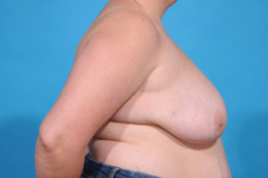 multiple staged breast reconstruction plan - dallas - bradley hubbard md BEFORE side
