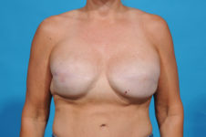 breast reconstruction revision - dallas - bradley hubbard md -JD pre front