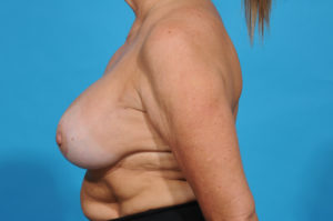 breast reconstruction - 54 yr old - dallas - bradley hubbard md - SA post side