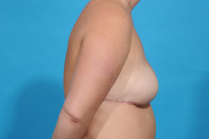 breast reconstruction - dallas - bradley hubbard md - SP post side