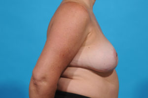 explant surgery in Dallas - before photos - Bradley Hubbard MD