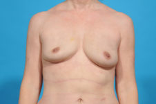 fat transfer breast augmentation surgery Dallas - before photo - Bradley Hubbard MD