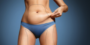 The Best Liposuction Surgeons In Dallas Should Be Telling You This - Bradley Hubbard MD Dallas Plastic Surgeon